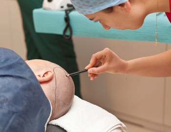 Transplantasi Rambut dengan Sedasi