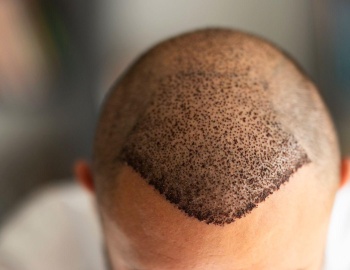 Hybrid Hair Transplant