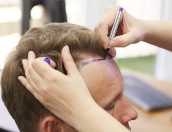 Kapan Rambut Yang Ditanam Kapan Tumbuh?