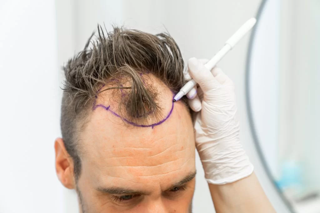 Proses Transplantasi Rambut di Turki: Dari Konsultasi Hingga Hasil Akhir