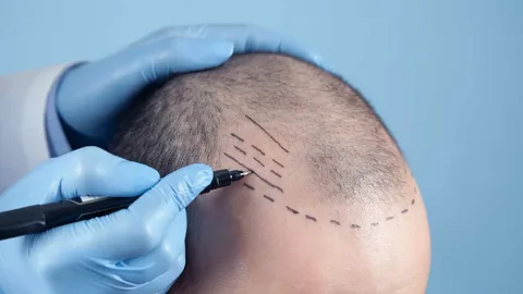 Teknik Transplantasi Rambut Modern di Turki