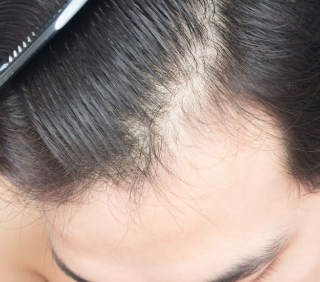 Transplantasi Rambut Tanpa Cukur (UFUE)