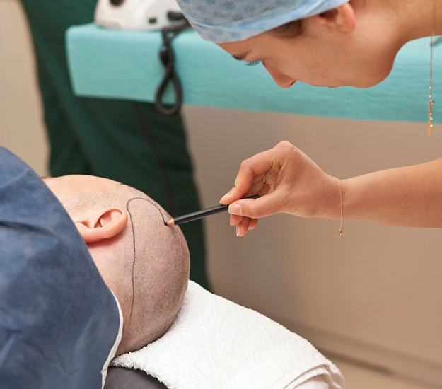 Transplantasi Rambut dengan Sedasi
