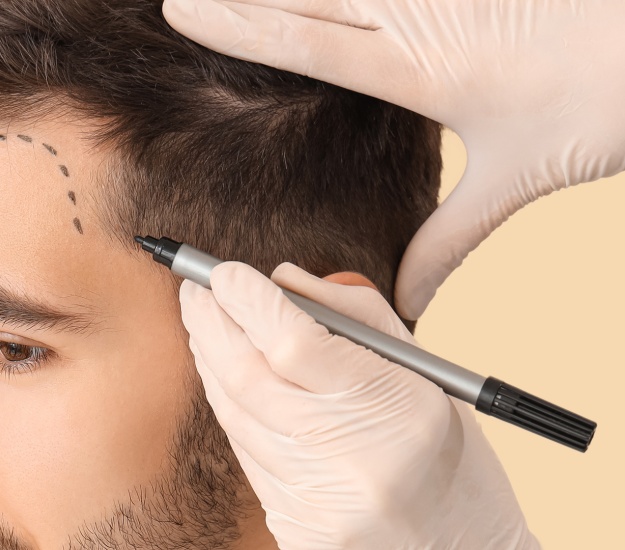 Transplantasi Rambut Turki